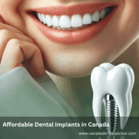 Affordable Dental Implants in Canada - Your Guide to Cost-Effective Solutions