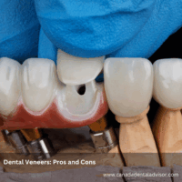 Dental Veneers: Pros and Cons