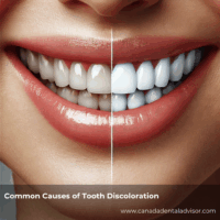 Common Causes of Tooth Discoloration