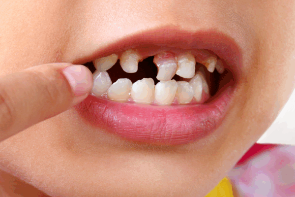 Common Dental Problems in Children
