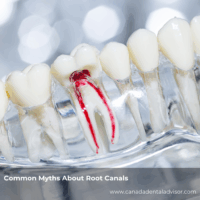 Common Myths About Root Canals