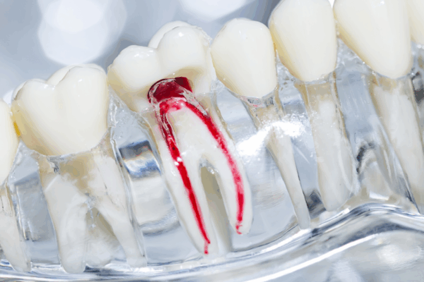 Common Myths About Root Canals