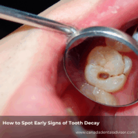 How to Spot Early Signs of Tooth Decay