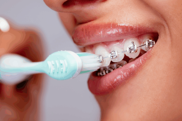 Tips for Brushing with Braces