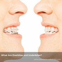 What Are Overbites and Underbites?