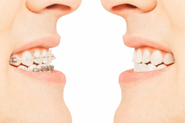 What Are Overbites and Underbites?