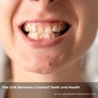 The Link Between Crooked Teeth and Health
