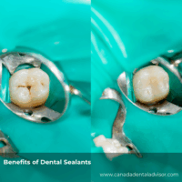 Benefits of Dental Sealants