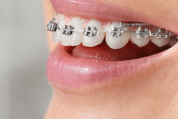 The Latest Trends in Orthodontic Treatments for Adults