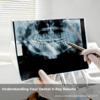 Understanding Your Dental X-Ray Results