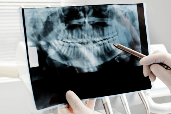 Understanding Your Dental X-Ray Results