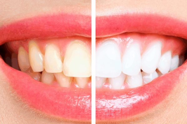 The Benefits and Risks of DIY Teeth Whitening at Home