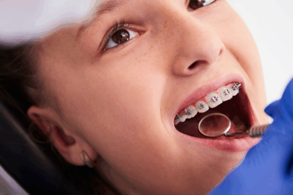 Dental Checkups for People with Braces: What’s Different?