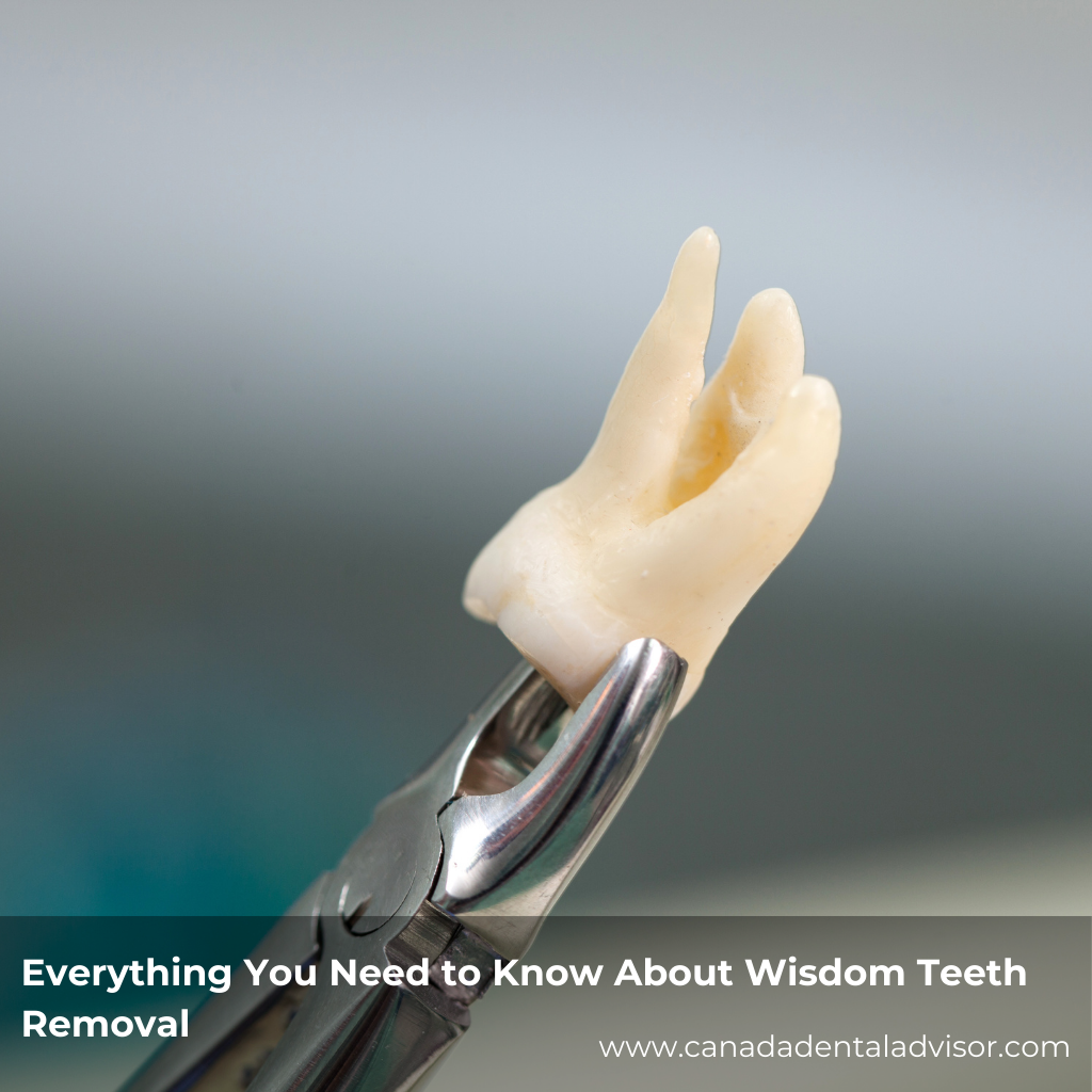 Everything You Need to Know About Wisdom Teeth Removal