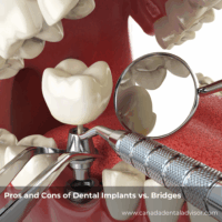 Pros and Cons of Dental Implants vs. Bridges
