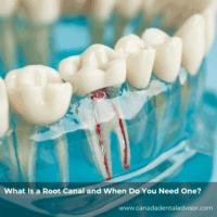 What Is a Root Canal and When Do You Need One?