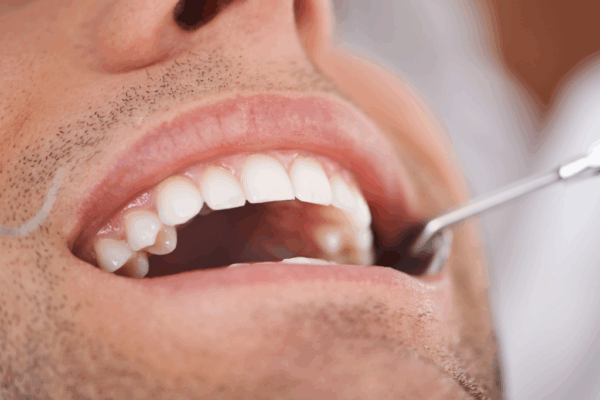 Why Bi-Annual Cleanings Are Crucial