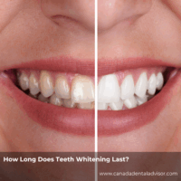 How Long Does Teeth Whitening Last?