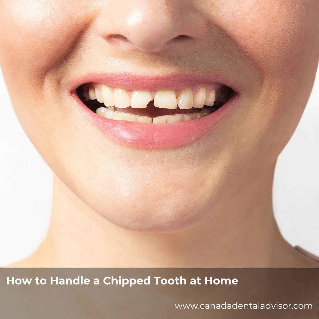How to Handle a Chipped Tooth at Home