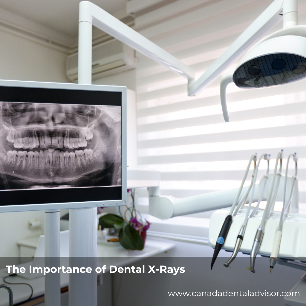 The Importance of Dental X-Rays