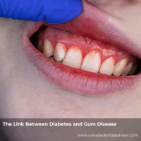 The Link Between Diabetes and Gum Disease