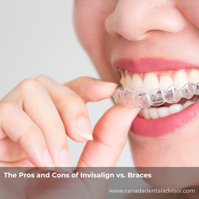 The Pros and Cons of Invisalign vs. Braces