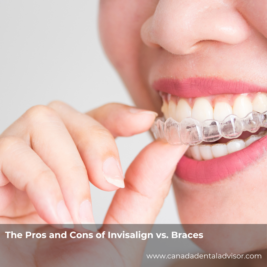 The Pros and Cons of Invisalign vs. Braces