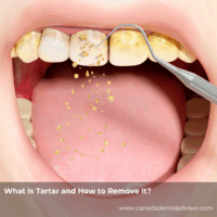 What Is Tartar and How to Remove It?