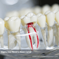 Signs You Need a Root Canal