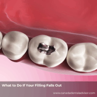 What to Do If Your Filling Falls Out