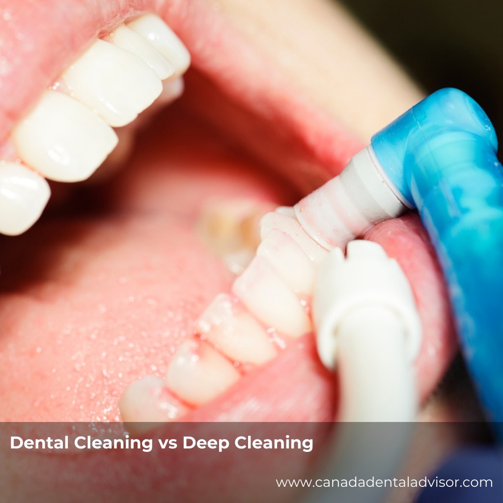 Dental Cleaning vs Deep Cleaning