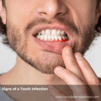 Signs of a Tooth Infection