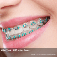 Why Teeth Shift After Braces