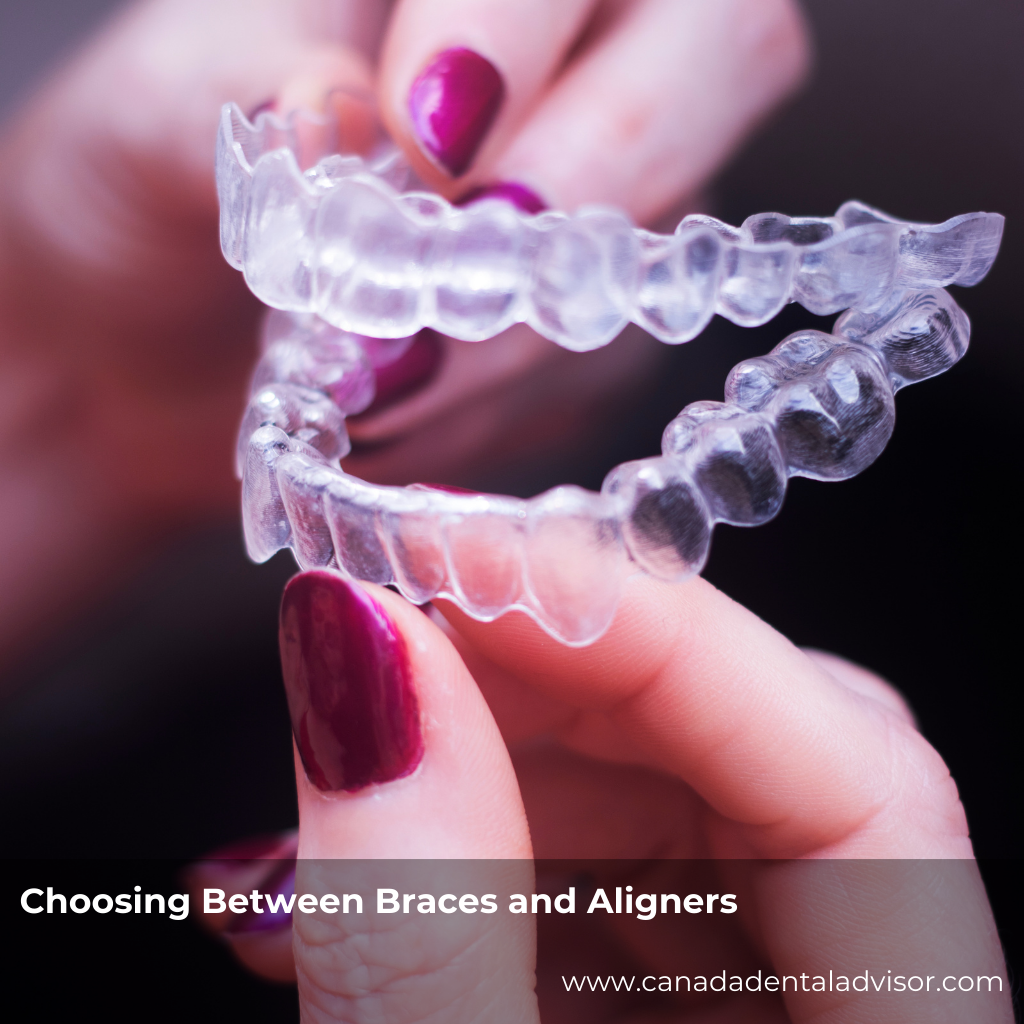 Choosing Between Braces and Aligners