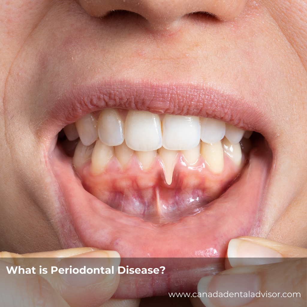 What is Periodontal Disease?