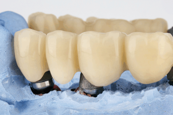 What is a Dental Bridge?