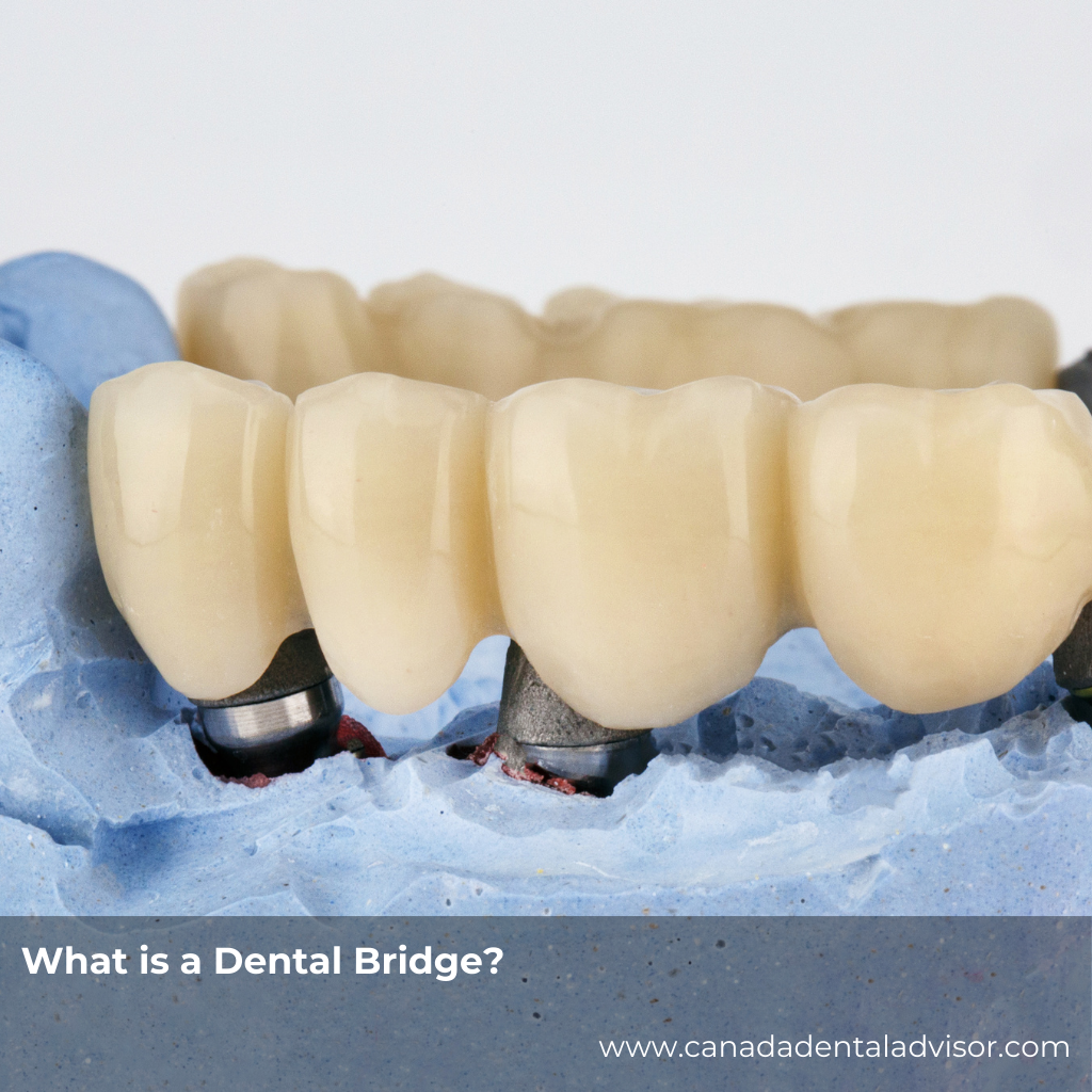 What is a Dental Bridge?