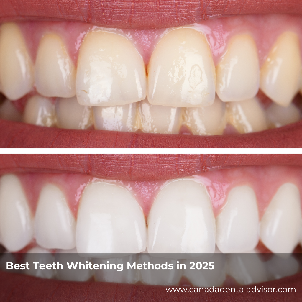 Best Teeth Whitening Methods in 2025
