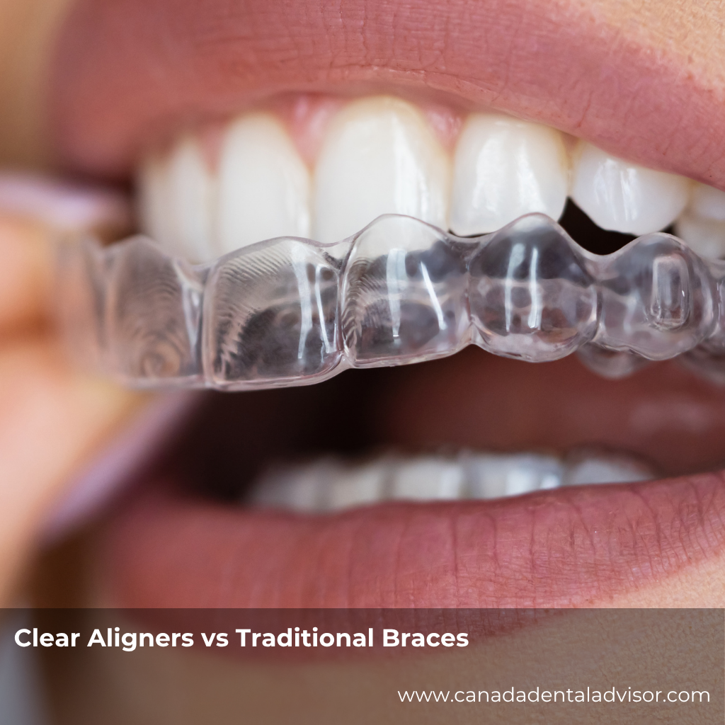 Clear Aligners vs Traditional Braces