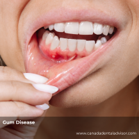Gum Disease: Symptoms and Treatment