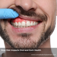 How Diet Impacts Oral and Gum Health