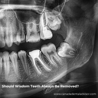Should Wisdom Teeth Always Be Removed?