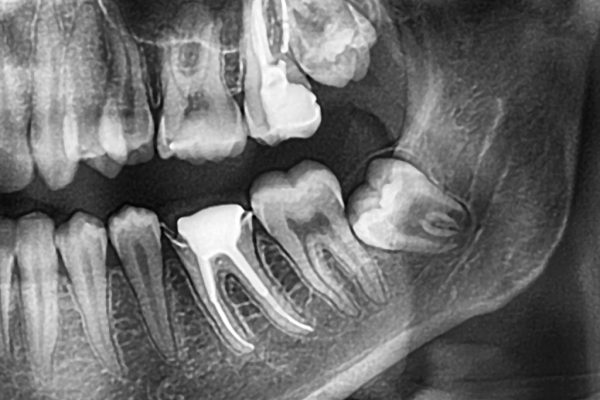 Should Wisdom Teeth Always Be Removed?