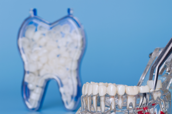 What is a Dental Crown?
