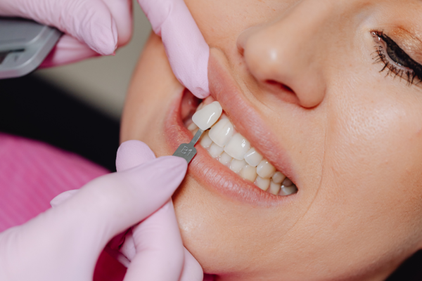 What is a Dental Veneer?