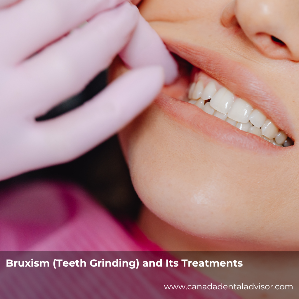 Bruxism (Teeth Grinding) and Its Treatments