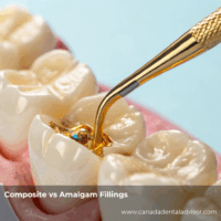 Composite vs Amalgam Fillings