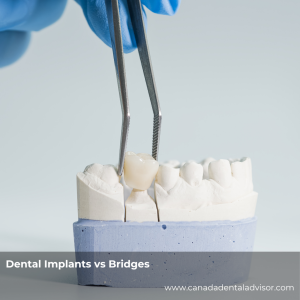 Dental Implants vs Bridges