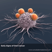 Early Signs of Oral Cancer
