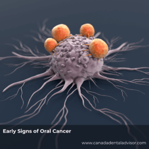 Early Signs of Oral Cancer